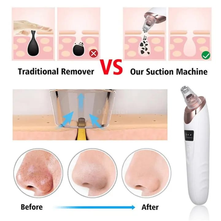 Blackhead Remover | Face Acne Black Dot Pimple Electric Blackhead Vacuum Cleaner